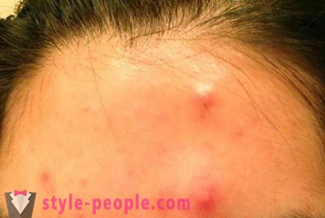 Wat betreft de nacht om zich te ontdoen van acne thuis?