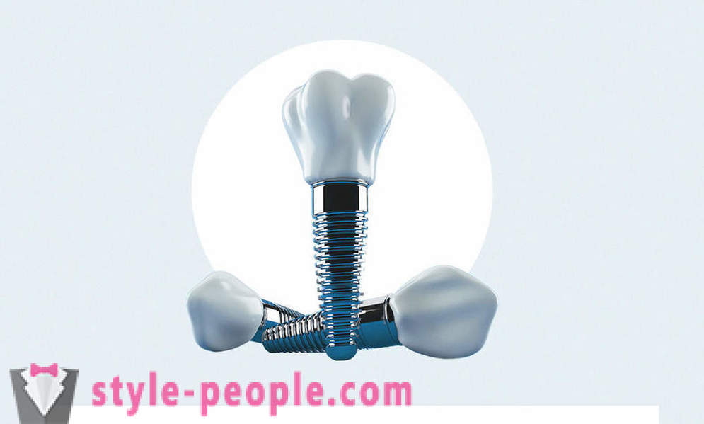 8 vragen over tandheelkundige implantaten