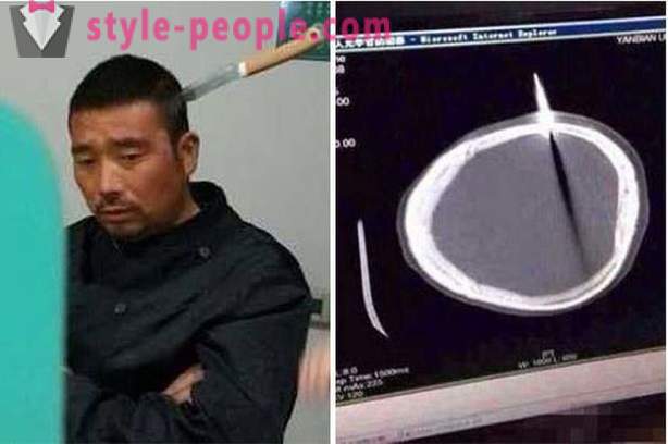 Een Chinese man met een mes in zijn hoofd ging hij naar de dokter