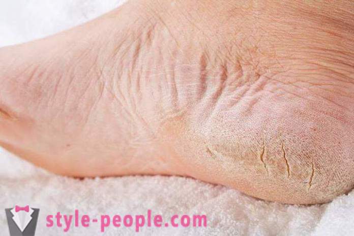 Droge huid op je voeten: Oorzaken