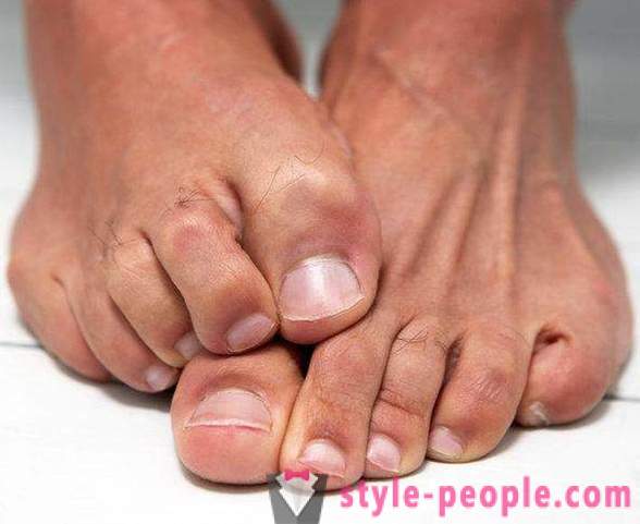 Droge huid op je voeten: Oorzaken