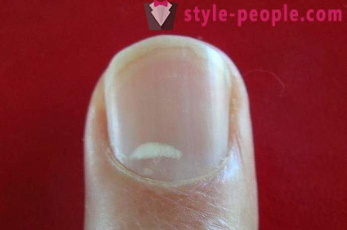 Wat betekenen de witte vlekken op de nagels