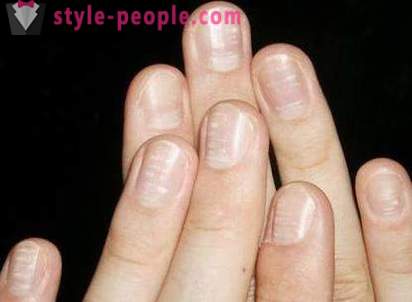 Wat betekenen de witte vlekken op de nagels