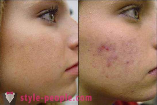 We behandeling van acne littekens