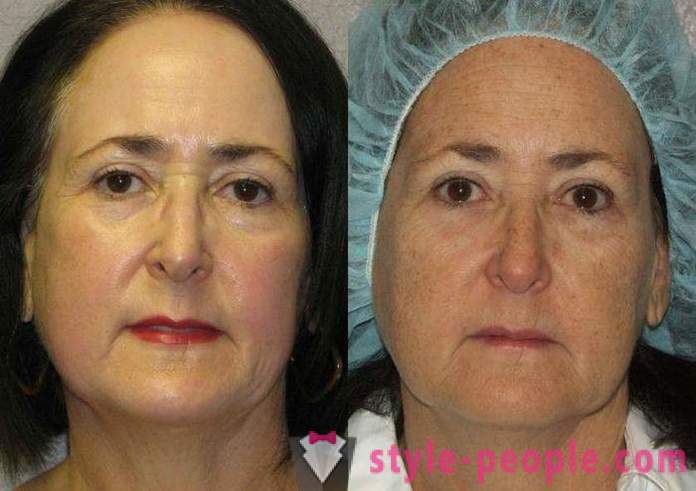 Laser resurfacing van het gezicht - een veilige manier om te verjongen
